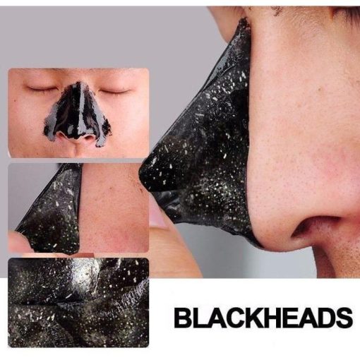 best blackhead remover